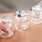 cupping